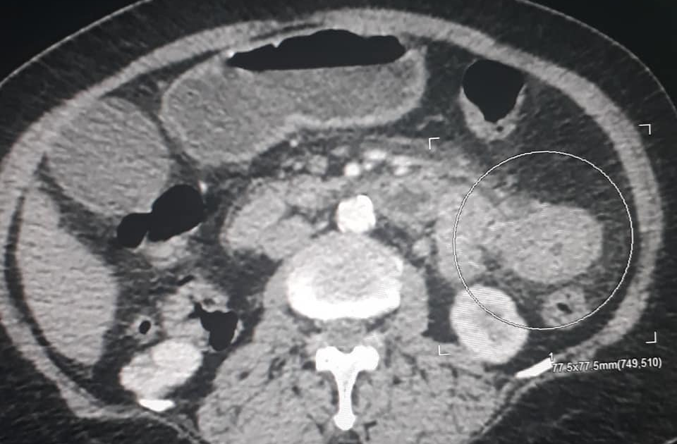 Scanner abdominale hématome parietal