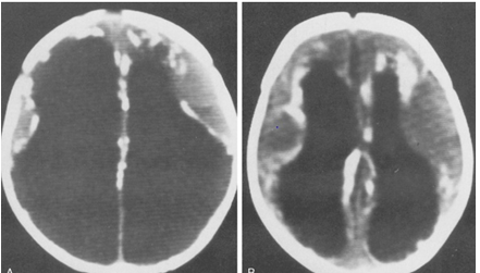 abnormal mri brain