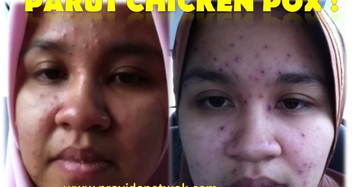 Ubat Chicken Pox Untuk Dewasa - Contoh 0108