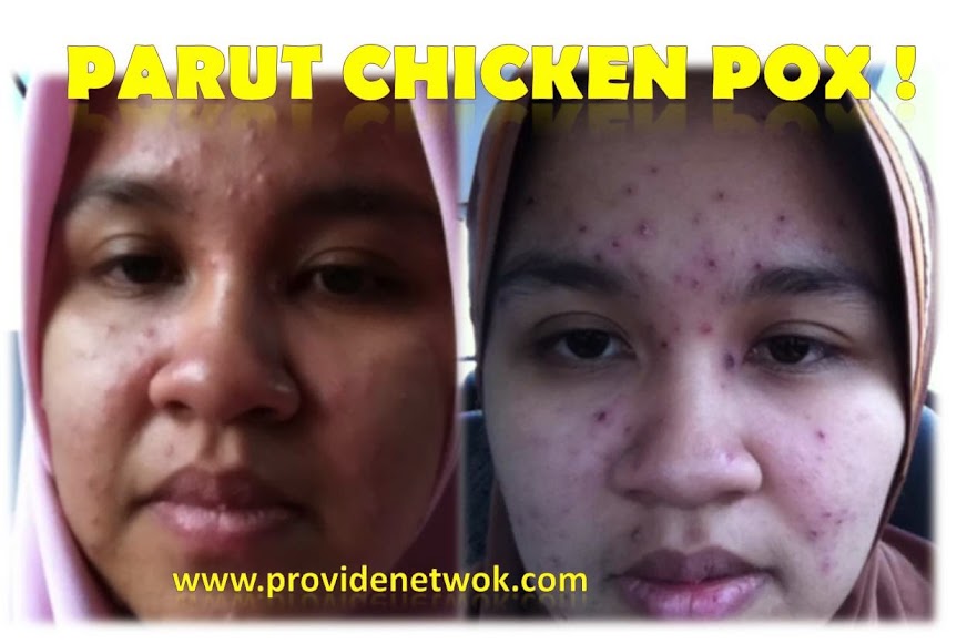 Cara Hilangkan Parut Chicken Pox Dewasa Untuk Wajah Lebih 