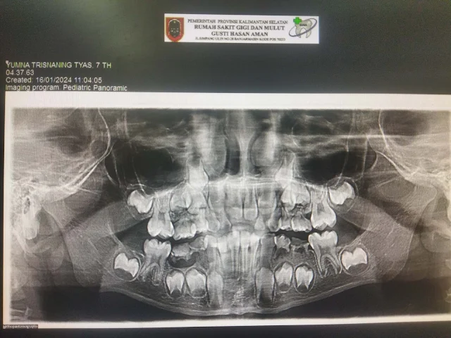 hasil rontgen gigi panoramic