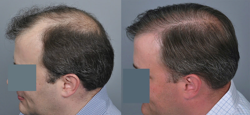 hair-transplant-charlotte-3.jpg