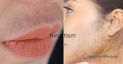 Hirustism (Execessive hair growth in women)