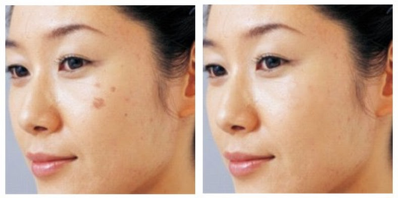 trị nám da bằng công nghệ laser