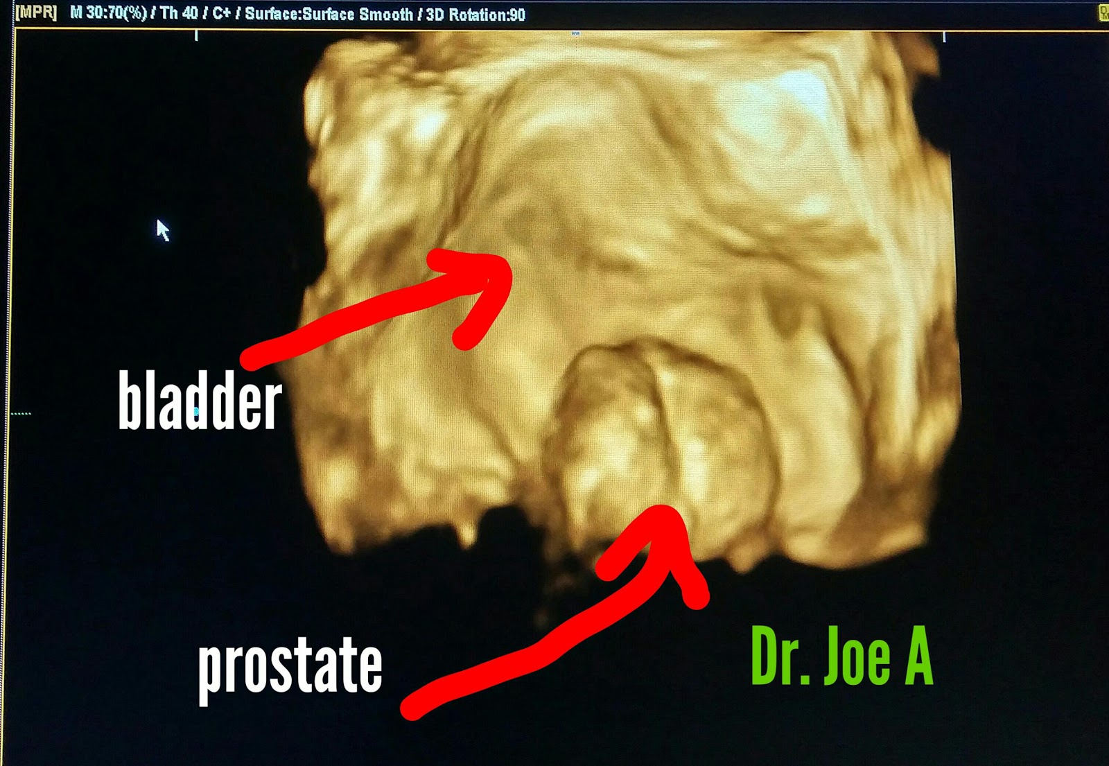 Ultrasound imaging: Unusually large prostate 3D ultrasound