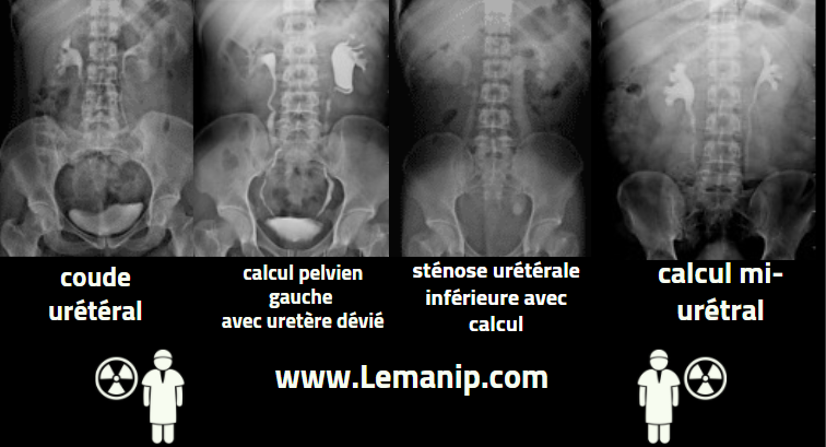 Technique du UIV Urographie Intraveineuse