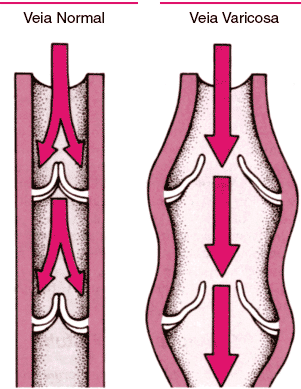 tratamiento para estrias blancas