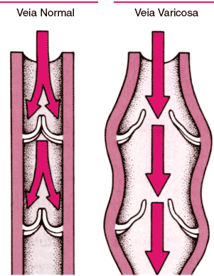 tratamento para varizes