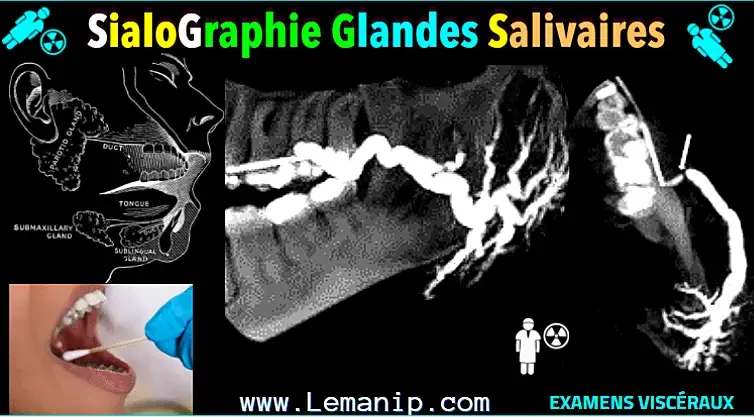 removing salivary gland,sjogren's swollen glands,left parotid,parotid duct,stensen's duct,parotid gland duct,swollen parotid glands both sides,swollen parotid gland on both sides,superficial parotid,inflamed salivary gland