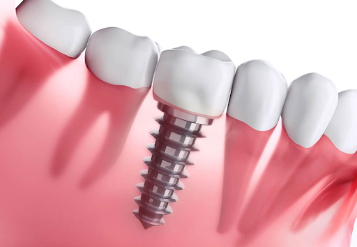 What circumstance we need dental implants?