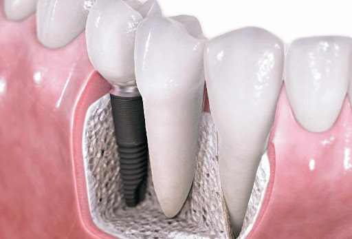 dental implants