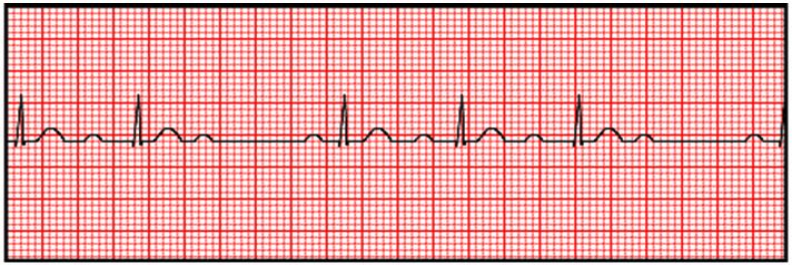 Conduction Blocks at the AV Node (AV Blocks) [With Examples