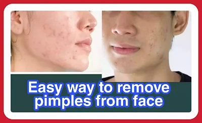 Easy way to remove pimples from face