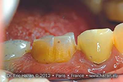 Passage des points de contact. Docteur Eric Hazan, chirurgien-dentiste / dental surgeon, Paris 16, France