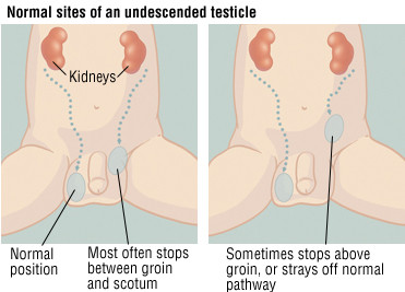 Undescended Testicle