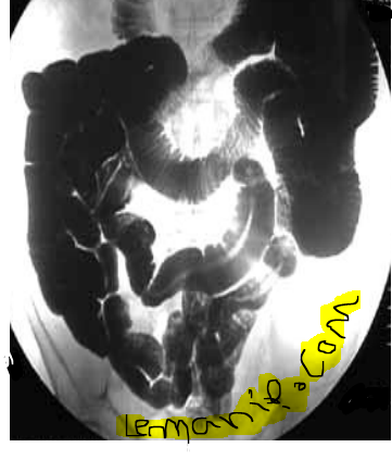 eosinophilic esophagitis symptoms in adults,ee esophagus,esophagitis endoscopy,the gastro group,dr rubin gastro,dr gold gastro,vanguard gastro,gj gastro,duodenal neuroendocrine tumor,esophageal esophagitis