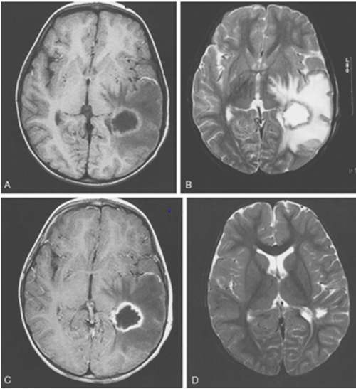 abnormal mri brain