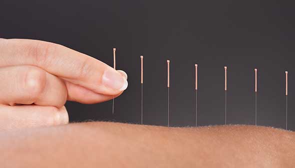 Acupuncture1