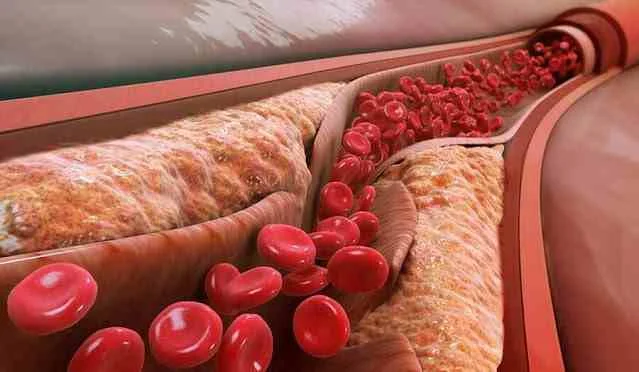 اعراض ارتفاع نسبة الكولسترول في الدم