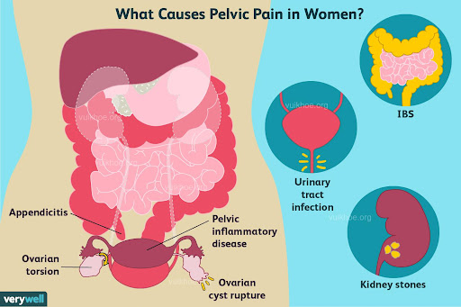 Common causes of pelvic pain in women