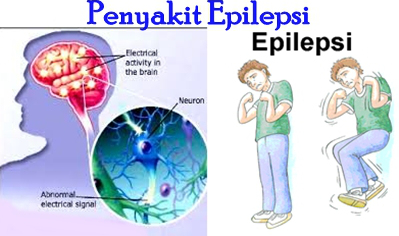 Cara Mengobati Ayan Epilepsi