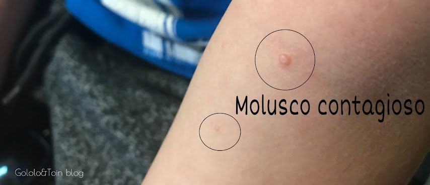 cómo es un molusco contagioso