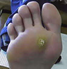 Mẹo chữa hạt cơm, mụn cóc đơn giản mà hiệu quả