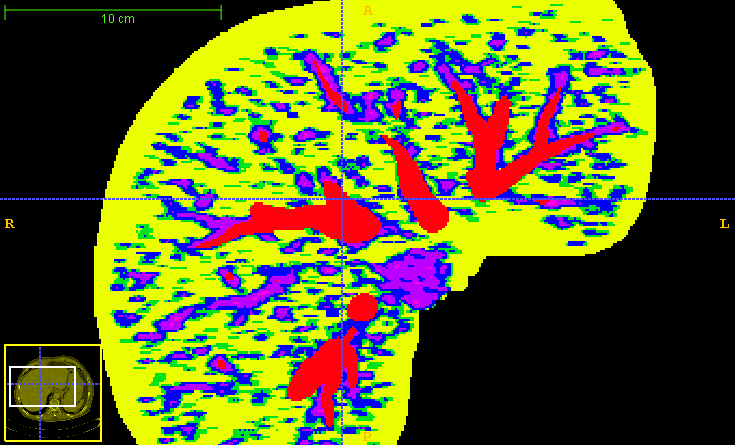 Vessel detection result on CT images (liver)