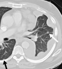 <strong>mesothelioma</strong> chest x ray