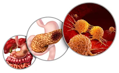 Are stomach cancer symptoms constant Are stomach cancer symptoms constant