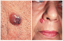 파일:external/www.skincancer.org/bcc-bump-1.jpg