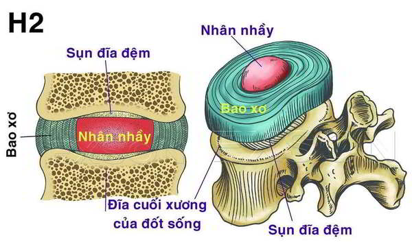 Dấu hiệu bệnh lý thoát vị đĩa đệm cột sống như thế nào 4-buoc-chua-benh-viem-khop-goi