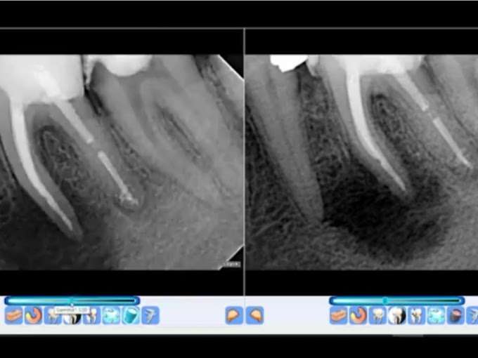 Chllenging endodontic case 