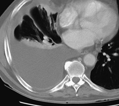 mesothelioma chest x ray