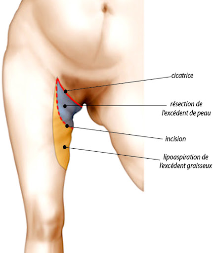 incision lifting des cuisses