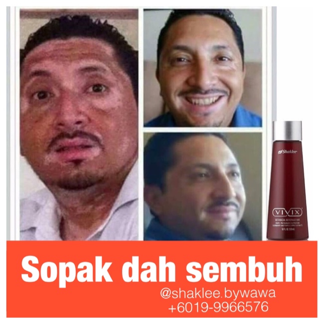 Testimoni Sopak Sembuh Dengan Vivix - VIVIX UNTUK SEMUA