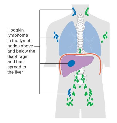 Askep Pasien Dengan Limfoma Hodgkin