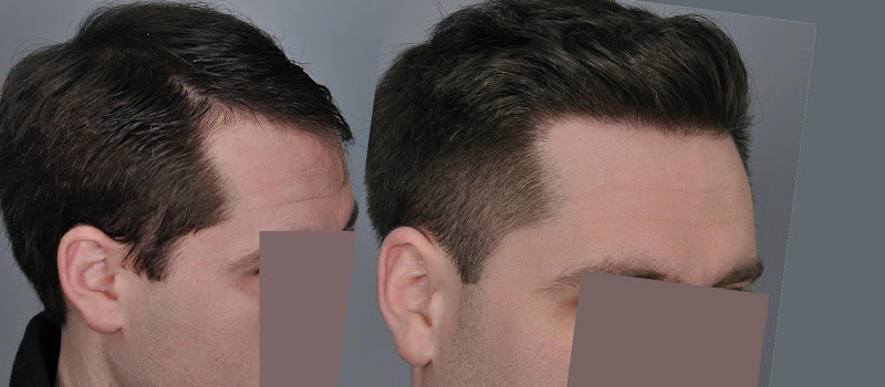 hair-transplant-1768-left-temple.jpg