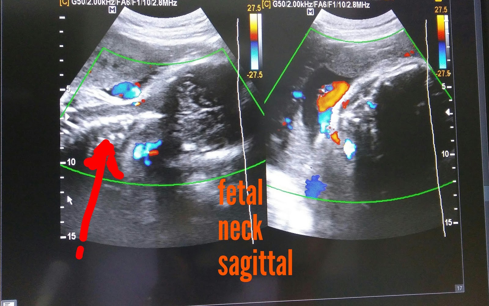 cord presentation ultrasound