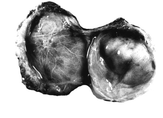 Bilobed immature placenta of Hanuman langur, with cord insertion on the larger left lobe