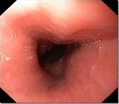Normal esophagus endoscopic view