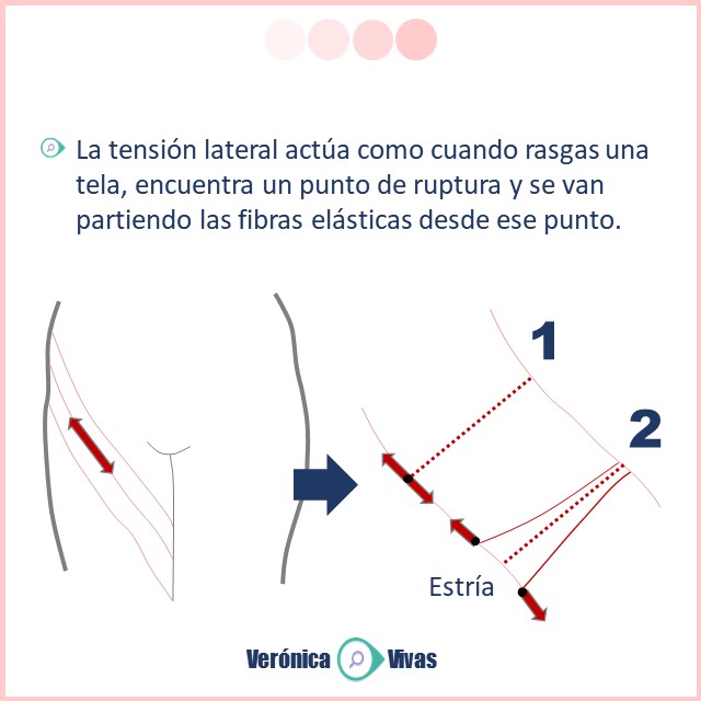 Patrón de estrías y Flacidez: Líneas de Kraissl y líneas de Langer