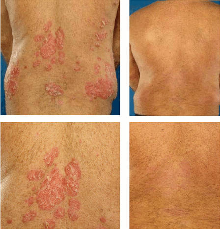 Las tesis sobre la psoriasis