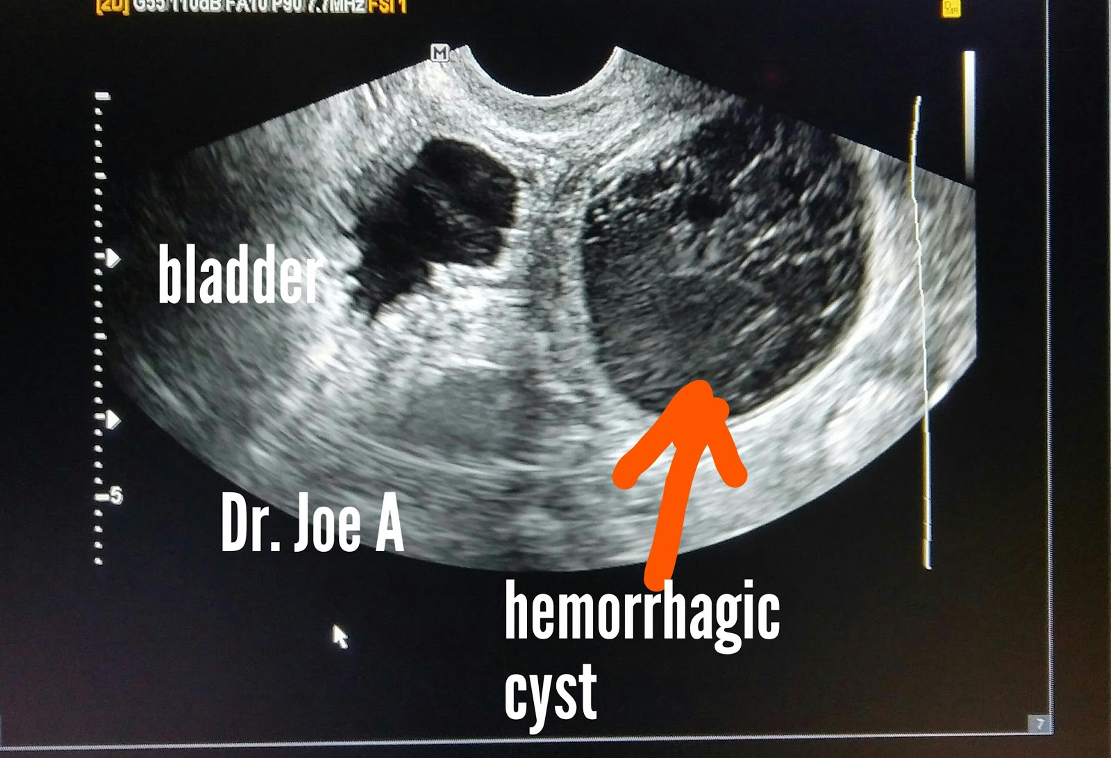 Hemorrhagic Cyst Ultrasound