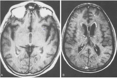 abnormal mri brain