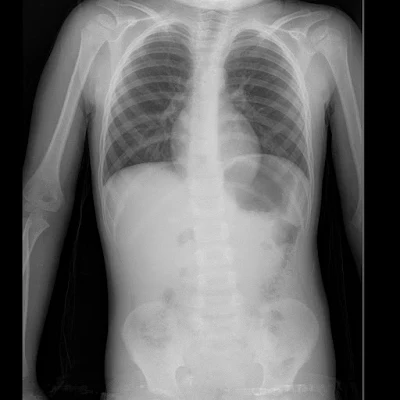 mesothelioma chest x ray,mesothelioma x ray,asbestosis chest x ray,asbestos lung x ray,asbestosis x ray,asthma x ray,asthma chest x ray,asthma lungs x ray,fractured rib xray,cracked ribs xray