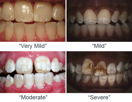 Fluorosis 