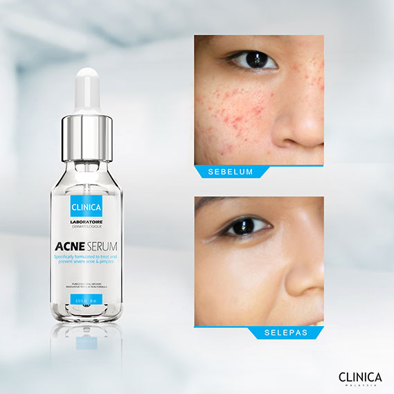 Mazim's Beauty Outlet: Clinica Acne Serum : Ubat Jerawat 