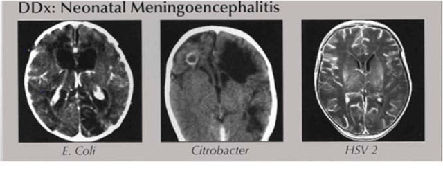 abnormal mri brain meningitis 2