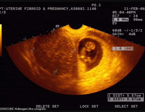 vivix dan fibroid